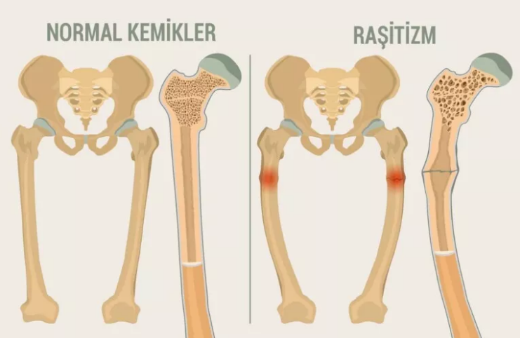 Raşitizm